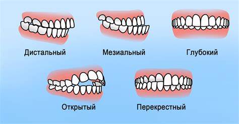 Неправильный прикус – методы исправления